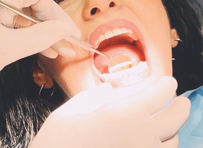 Blog 1 Come si fa la pulizia dei denti