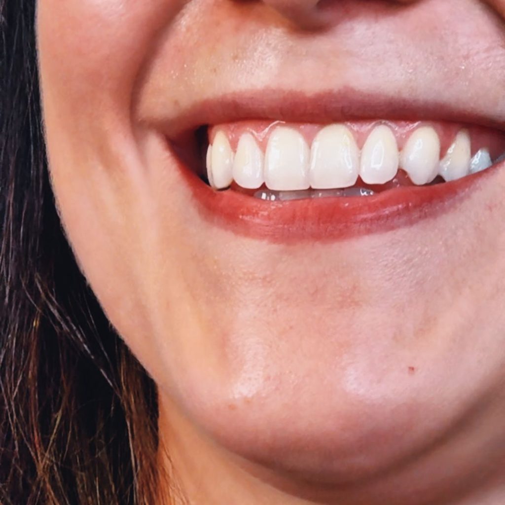 Faccette Dentali 1 Faccette dentali ad Alessandria