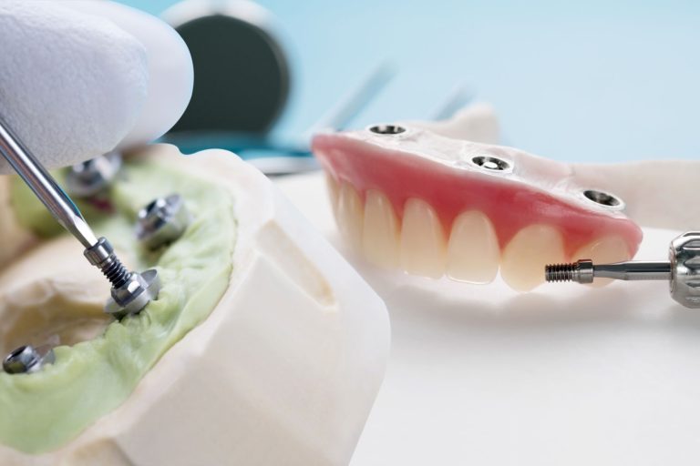Blog 1 Quanto costa un impianto dentale