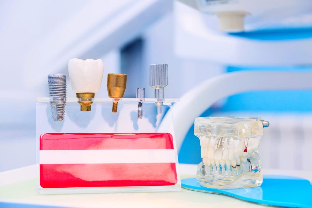 Quanto dura un impianto dentale 1 Quanto dura un impianto dentale