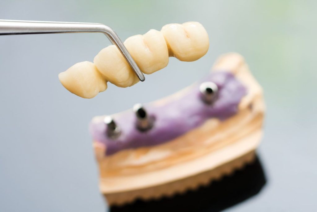 Quanto costa un impianto dentale 1 Quanto costa un impianto dentale