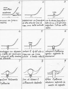 Dispositivo per il mini rialzo di seno mascellare 1 Dispositivo per il mini rialzo di seno mascellare